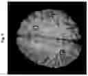 Fig. 06 - Device and method for detecting cerebral microbleeds using magnetic resonance images