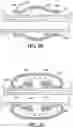 Fig. 11 - Enhanced Balloon Bonding For Balloon Guide Catheters While Minimizing Outer Profiles