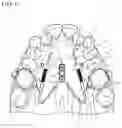 Fig. 02 - Tooth moving device