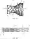 Fig. 02 - Assemblies and methods of sterilizing a wet stored implant