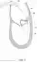 Fig. 02 - Methods, implants, and systems for treatment of mitral valve prolapse