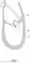 Fig. 06 - Methods, implants, and systems for treatment of mitral valve prolapse