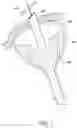 Fig. 08 - Methods, implants, and systems for treatment of mitral valve prolapse