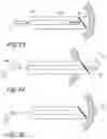 Fig. 09 - Methods, implants, and systems for treatment of mitral valve prolapse