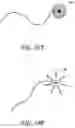 Fig. 11 - Methods, implants, and systems for treatment of mitral valve prolapse