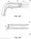 Fig. 13 - Methods, implants, and systems for treatment of mitral valve prolapse