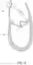 Fig. 15 - Methods, implants, and systems for treatment of mitral valve prolapse