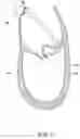Fig. 16 - Methods, implants, and systems for treatment of mitral valve prolapse