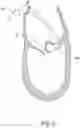Fig. 18 - Methods, implants, and systems for treatment of mitral valve prolapse
