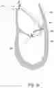 Fig. 19 - Methods, implants, and systems for treatment of mitral valve prolapse