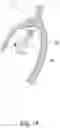 Fig. 20 - Methods, implants, and systems for treatment of mitral valve prolapse