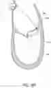 Fig. 21 - Methods, implants, and systems for treatment of mitral valve prolapse