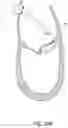 Fig. 22 - Methods, implants, and systems for treatment of mitral valve prolapse