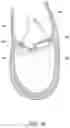 Fig. 28 - Methods, implants, and systems for treatment of mitral valve prolapse