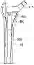 Fig. 01 - Custom hip design and insertability analysis