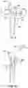 Fig. 06 - Custom hip design and insertability analysis