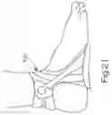 Fig. 21 - BRACE OR SUPPORT WITH ATFL SUPPORT