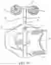 Fig. 08 - Thoracic lumbar sacral orthosis attachment