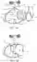 Fig. 09 - Thoracic lumbar sacral orthosis attachment