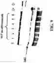 Fig. 11 - Identification of a JAK2 Mutation in Polycythemia Vera