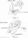 Fig. 02 - SURGICAL TOOL AND METHOD OF USE FOR CARPEL TUNNEL RELEASE PROCEDURE