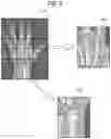 Fig. 06 - Apparatus, method and recording medium storing program for assessing bone age