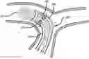 Fig. 01 - DYNAMIC ASPIRATION CATHETER AND METHODS