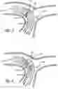 Fig. 03 - DYNAMIC ASPIRATION CATHETER AND METHODS