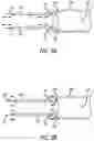 Fig. 04 - DYNAMIC ASPIRATION CATHETER AND METHODS