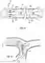 Fig. 07 - DYNAMIC ASPIRATION CATHETER AND METHODS