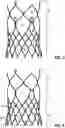 Fig. 03 - Prosthetic heart valve comprising a stent structure having a conical-convex inflow region and a linear cylindrical outflow region