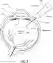 Fig. 03 - NEW AND IMPROVED VITRECTOR AND METHOD FOR PERFORMING A ONE-STEP POSTERIOR VITRECTOMY USING THE SAME