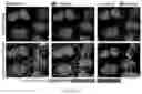 Fig. 53 - Agents for reversing toxic proteinopathies