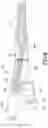 Fig. 06 - Dual lumen cannula