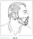 Fig. 16 - Ear mounted cannular nasal breathing filter