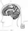 Fig. 02 - Adaptive deep brain stimulation of the superolateral medial forebrain bundle