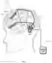 Fig. 03 - Adaptive deep brain stimulation of the superolateral medial forebrain bundle