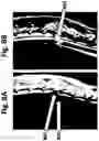 Fig. 09 - Superparamagnetic particle scaffold for regenerating damaged neural tissue