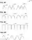 Fig. 05 - Systems and methods for neuromodulation of neuronal circuits using transcranial focused microwave pulses
