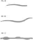 Fig. 08 - Braided cord with changing cross-sectional area