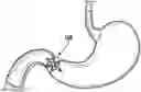 Fig. 01 - DEVICES, SYSTEMS, AND METHODS FOR PYLORIC OCCLUSION