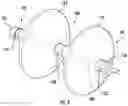 Fig. 03 - DEVICES, SYSTEMS, AND METHODS FOR PYLORIC OCCLUSION