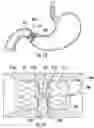 Fig. 07 - DEVICES, SYSTEMS, AND METHODS FOR PYLORIC OCCLUSION