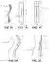 Fig. 02 - Systems and methods for endoluminal valve creation
