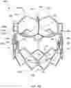 Fig. 05 - DEVICES AND METHODS FOR MULTI-ALIGNMENT OF IMPLANTABLE MEDICAL DEVICES