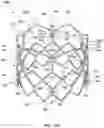 Fig. 25 - DEVICES AND METHODS FOR MULTI-ALIGNMENT OF IMPLANTABLE MEDICAL DEVICES