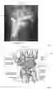 Fig. 02 - Implant for total wrist replacement
