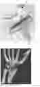 Fig. 03 - Implant for total wrist replacement