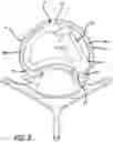 Fig. 04 - Spinal implant