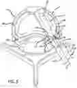 Fig. 06 - Spinal implant